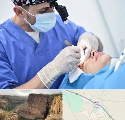 جراح سرطان چشم در سرپل ذهاب