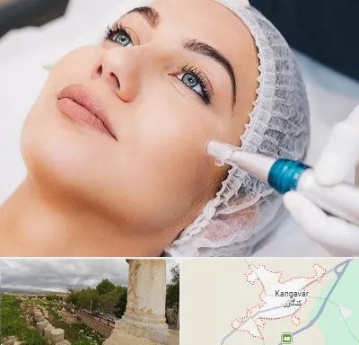 مزونیدلینگ در کنگاور