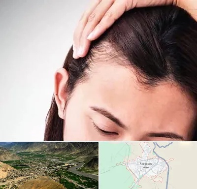 کاشت مو بانوان در اسدآباد