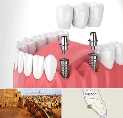 کاشت دندان در میبد