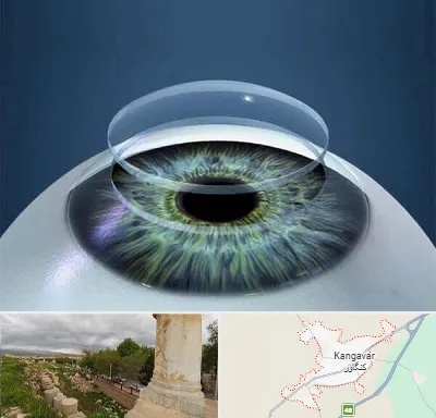 پیوند قرنیه در کنگاور