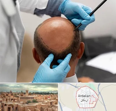 آموزش کاشت مو در اردکان