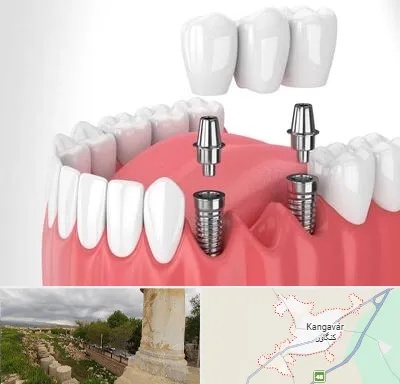 کاشت دندان در کنگاور