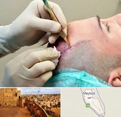 کلینیک کاشت مو در میبد