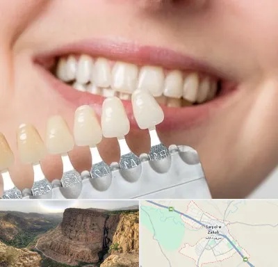 مرکز کامپوزیت دندان در سرپل ذهاب