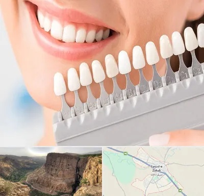 متخصص لمینت دندان در سرپل ذهاب