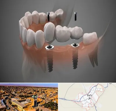 ایمپلنت دیجیتال در بافق