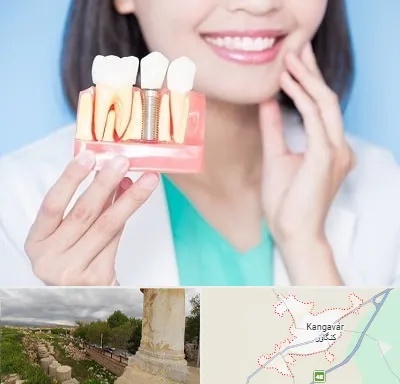 متخصص ایمپلنت در کنگاور