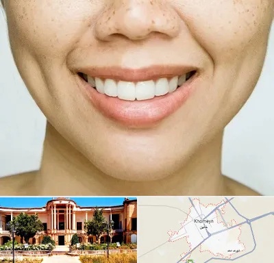 عمل چال گونه در خمین