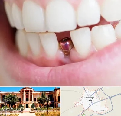 ایمپلنت اقساطی در خمین