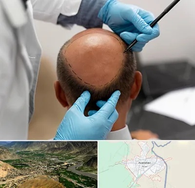 آموزش کاشت مو در اسدآباد