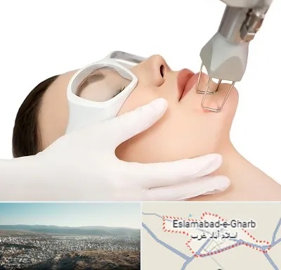 لیزر فرکشنال در اسلام آباد غرب