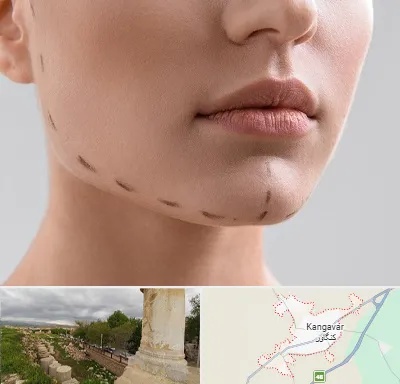 عمل زاویه فک در کنگاور