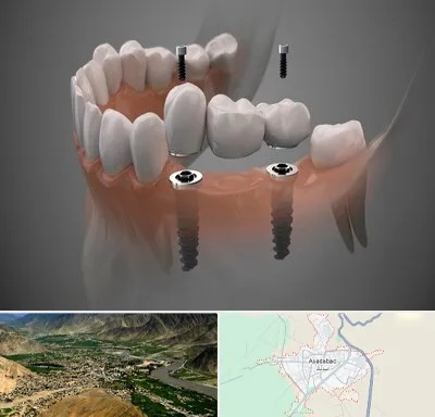 ایمپلنت دیجیتال در اسدآباد