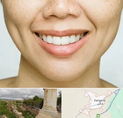 عمل چال گونه در کنگاور