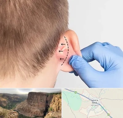عمل زیبایی گوش در سرپل ذهاب