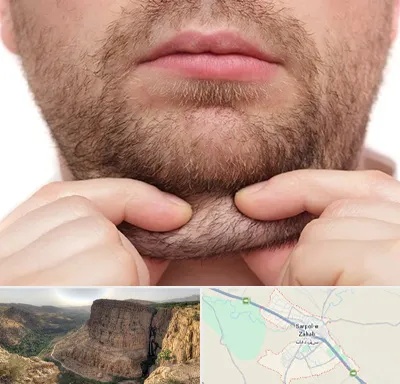 ساکشن غبغب در سرپل ذهاب