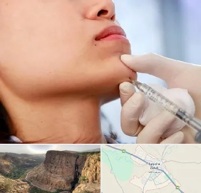 زاویه سازی صورت در سرپل ذهاب