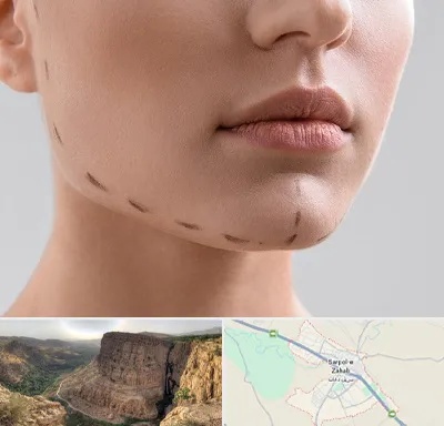 عمل زاویه فک در سرپل ذهاب