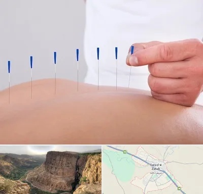 دکتر طب سوزنی در سرپل ذهاب