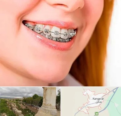 ارتودنسی ارزان در کنگاور