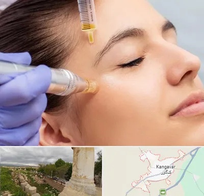میکرونیدلینگ در کنگاور