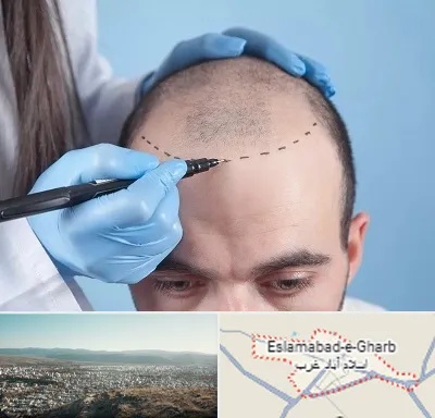 کاشت مو اقساطی در اسلام آباد غرب