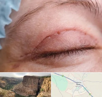 جراح پلک در سرپل ذهاب
