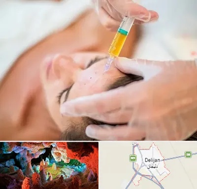 پی آر پی در دلیجان