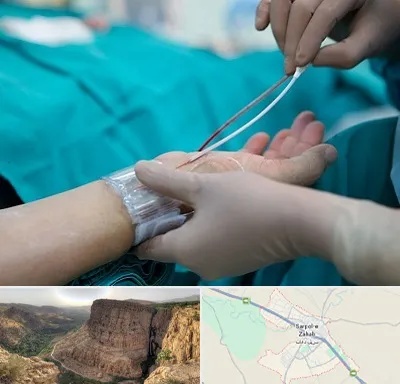 آنژیوگرافی در سرپل ذهاب