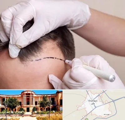 کاشت مو به روش SUT در خمین