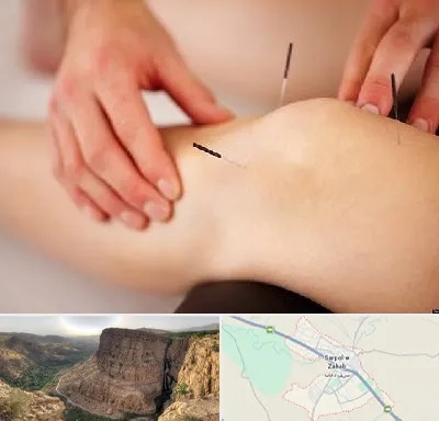 دکتر طب سوزنی برای لاغری در سرپل ذهاب