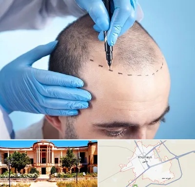 دکتر کاشت مو در خمین
