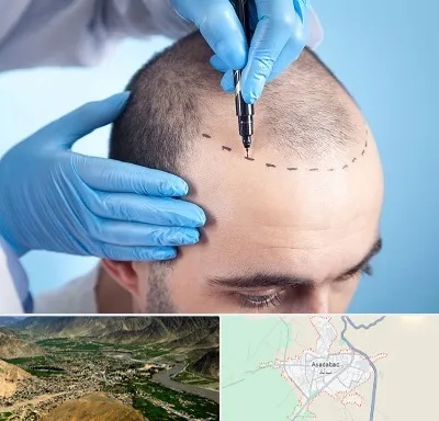 دکتر کاشت مو در اسدآباد