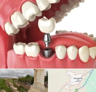 متخصص پروتز دندان در کنگاور