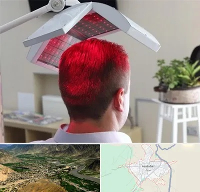 کاشت مو با لیزر در اسدآباد
