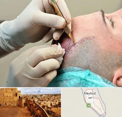 اسکالپ موی سر در میبد