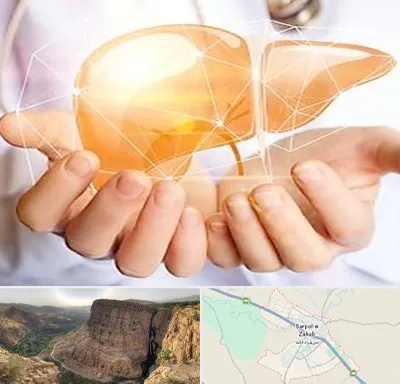 دکتر سرطان کبد در سرپل ذهاب