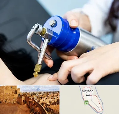 کرایوتراپی در میبد