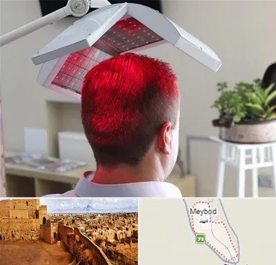 کاشت مو با لیزر در میبد