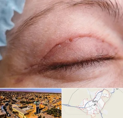 جراح پلک در بافق