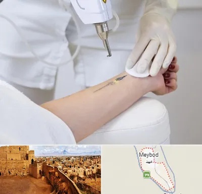 پاک کردن تتو با لیزر در میبد