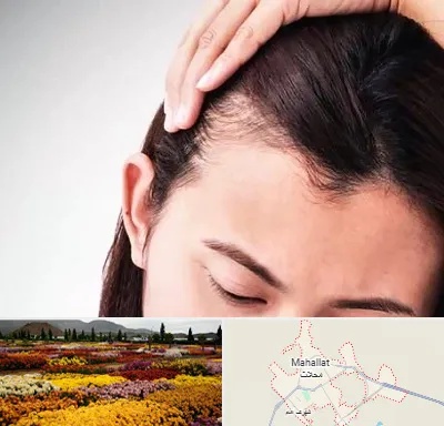 کاشت مو بانوان در محلات