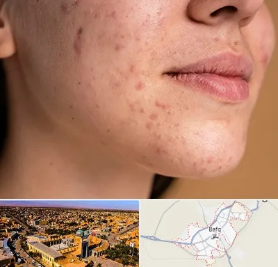 درمان جای جوش در بافق