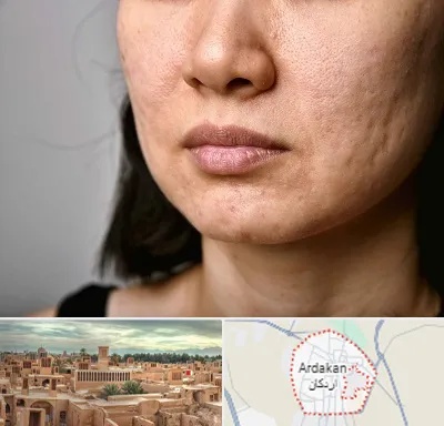 سابسیژن جای جوش در اردکان