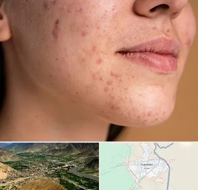 درمان جای جوش در اسدآباد