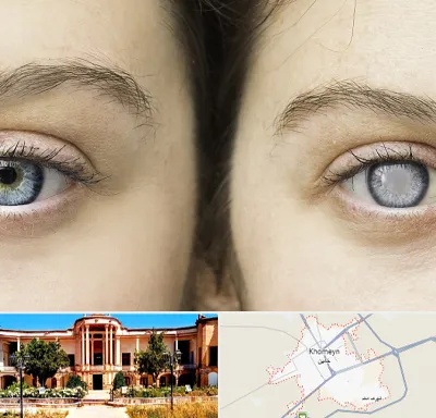 متخصص آب سیاه (گلوکوم) در خمین