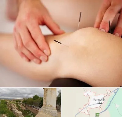 دکتر طب سوزنی برای لاغری در کنگاور