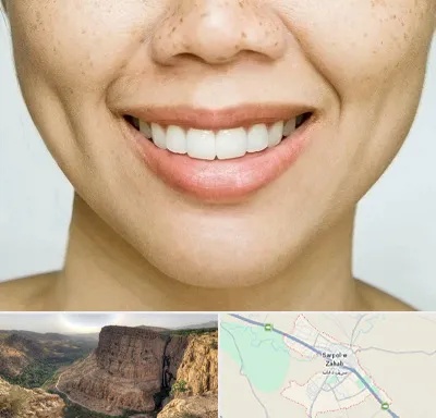 عمل چال گونه در سرپل ذهاب