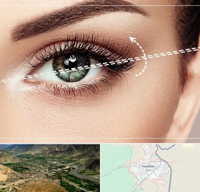 جراحی چشم گربه ای در اسدآباد